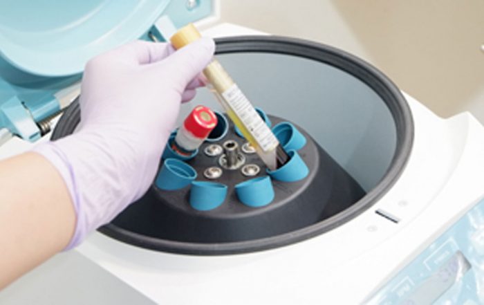 PLATELET RICH PLASMA (PRP)